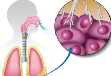 Mesothelioma Cases