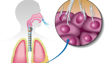 Mesothelioma Cases