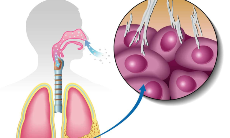 Mesothelioma Cases